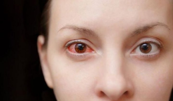 Viêm kết mạc sau mổ Lasik: Nguyên nhân, cách khắc phục